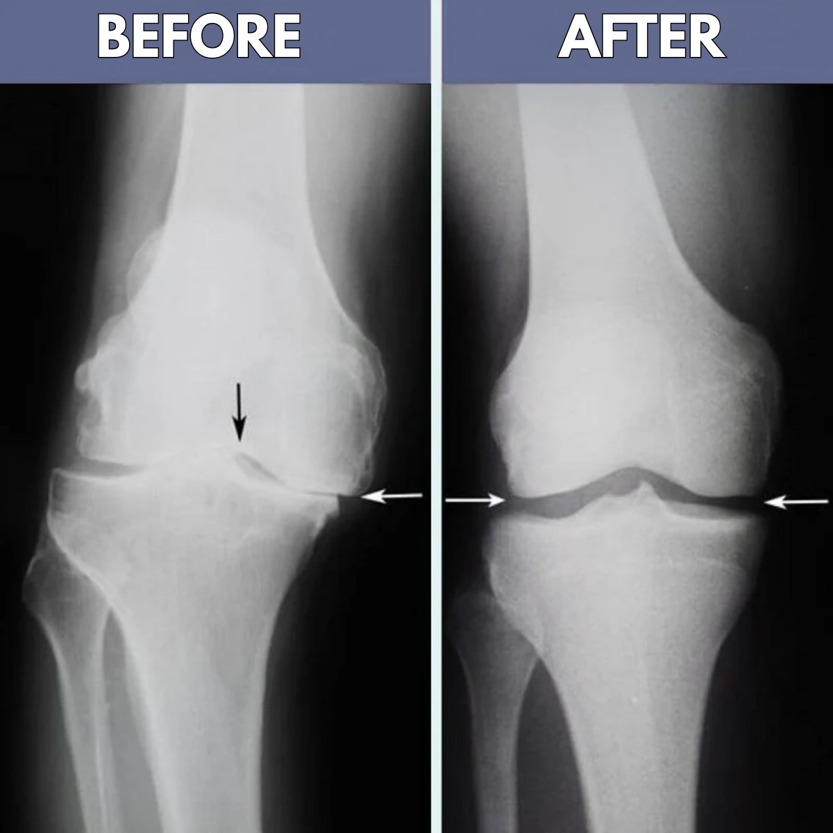 FisioKnee™ - No more knee pain. Move freely, move powerfully
