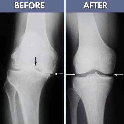 FisioKnee™ - No more knee pain. Move freely, move powerfully