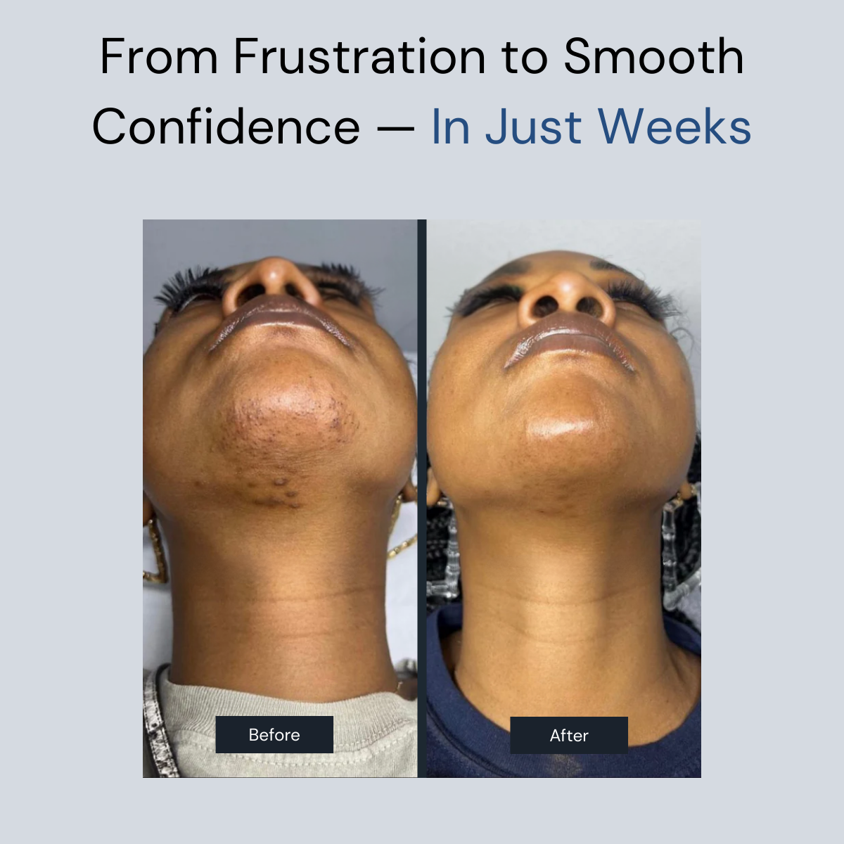 Zenvira Cyperus™- Smooth Skin Zero Pain