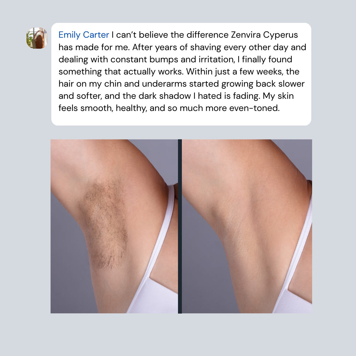 Zenvira Cyperus™- Smooth Skin Zero Pain