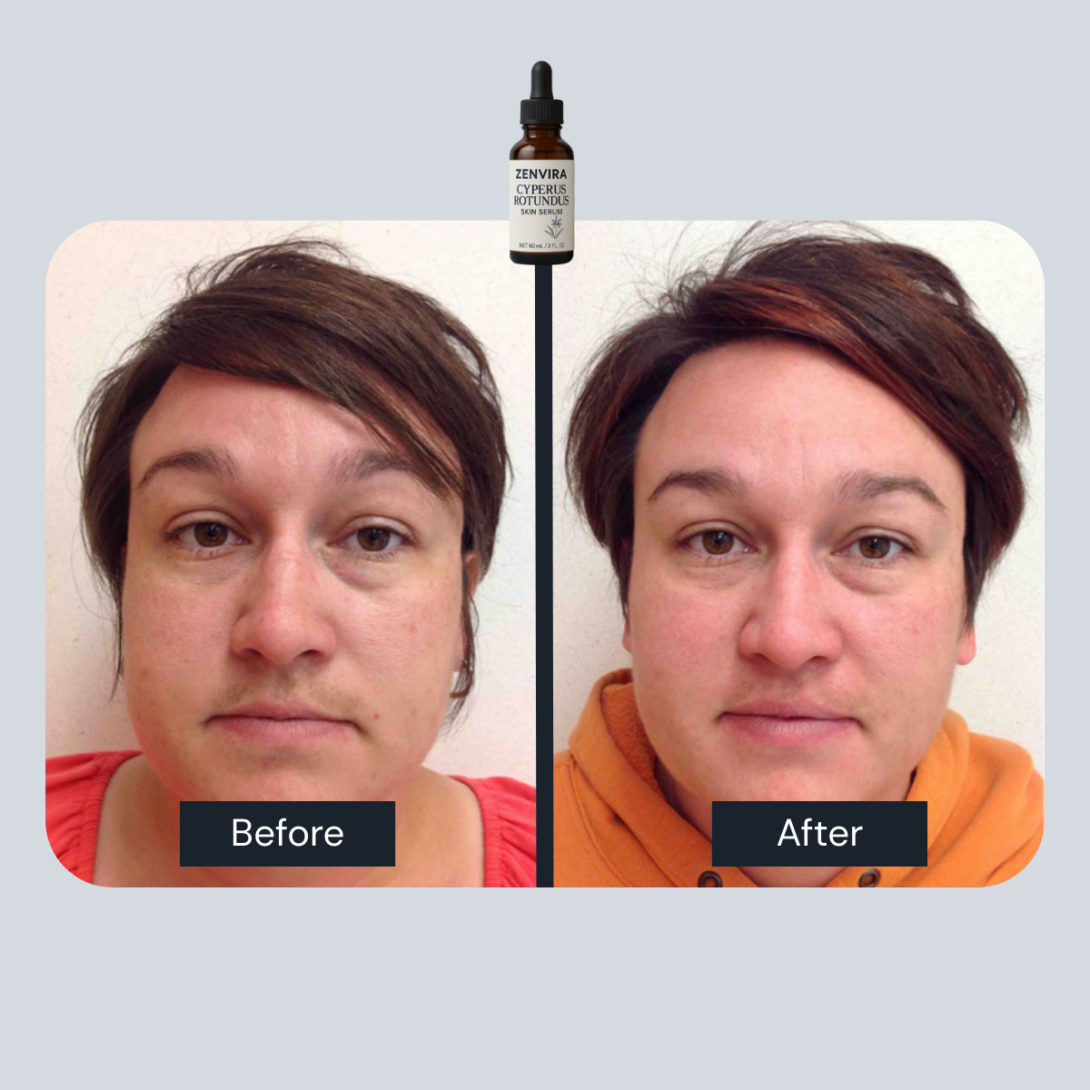 Zenvira Cyperus™- Smooth Skin Zero Pain